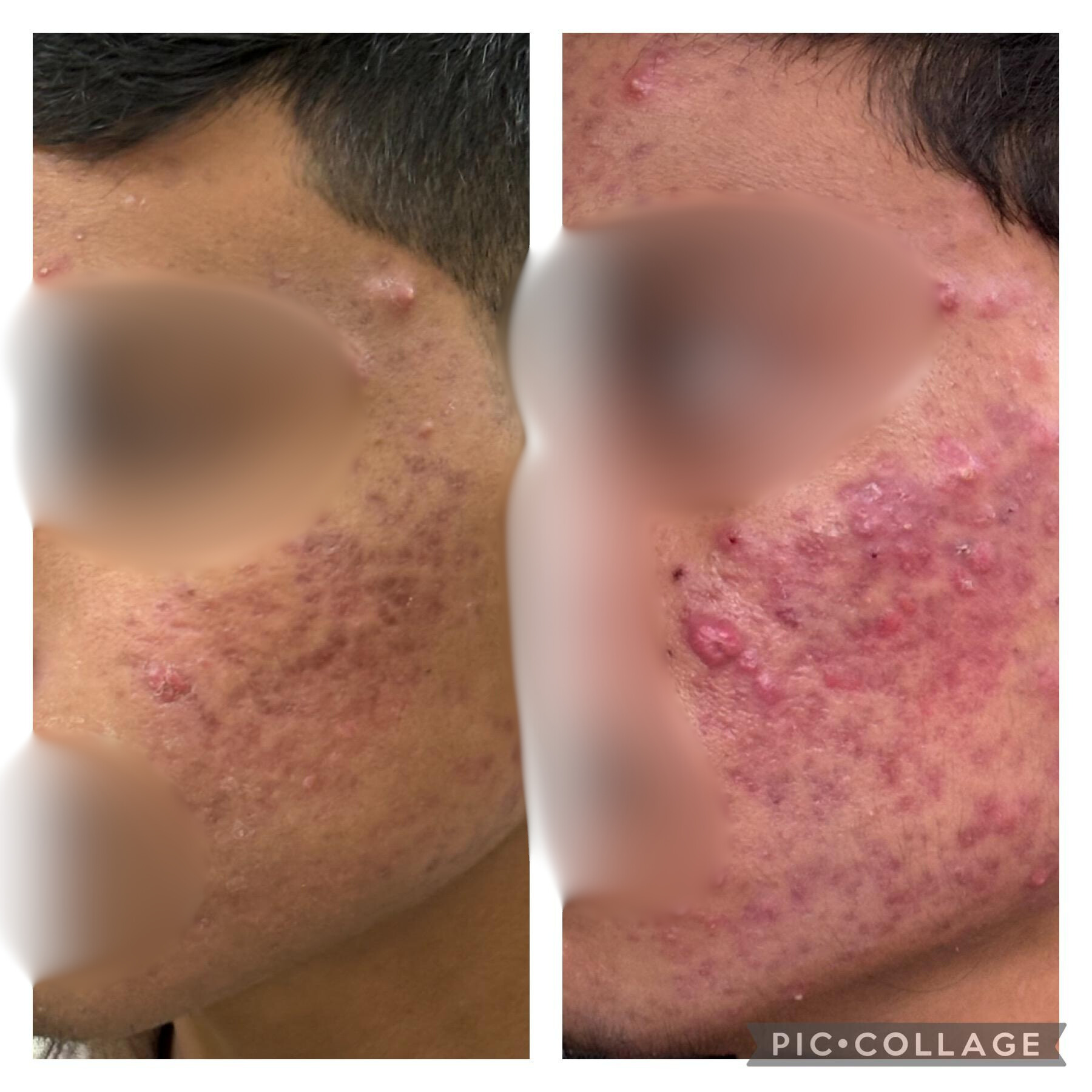 Before and After Treatment 1