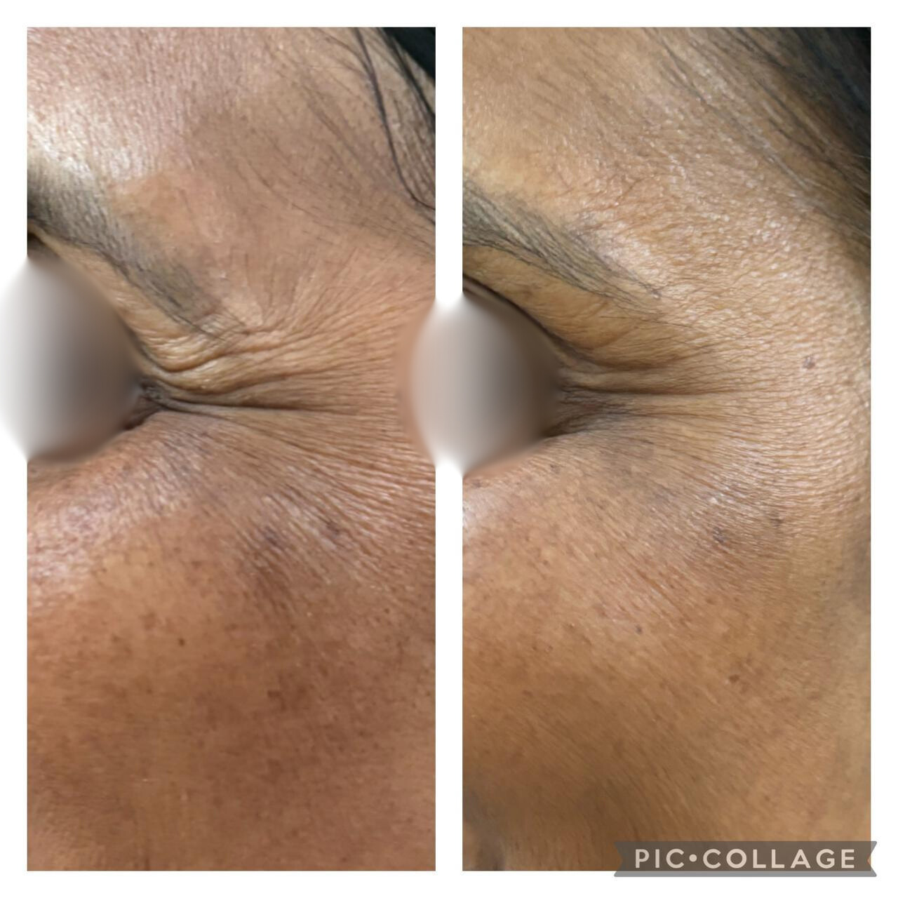 Before and After Treatment 2