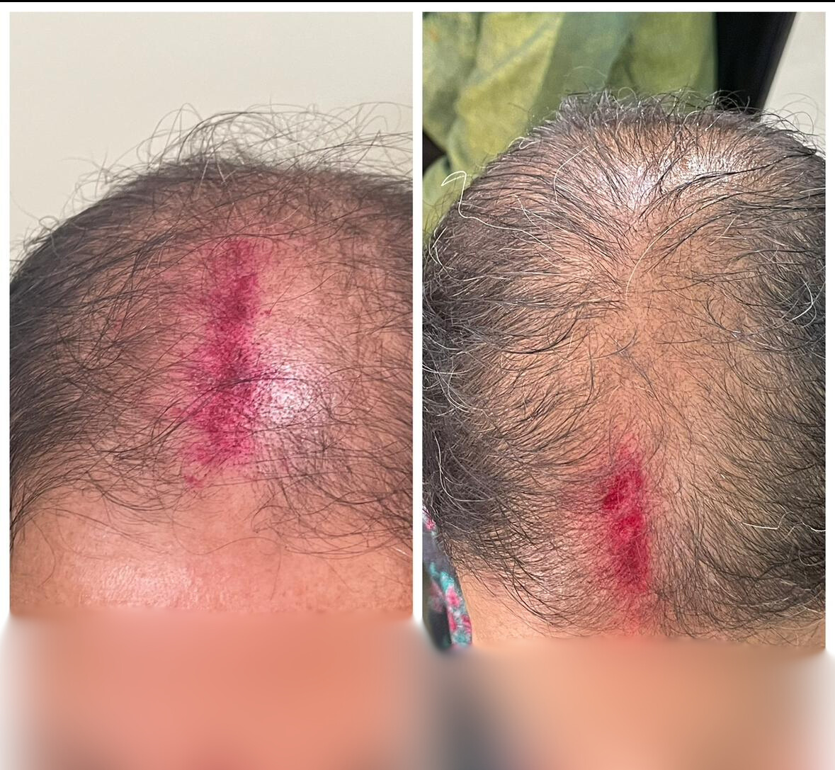 Before and After Treatment 1