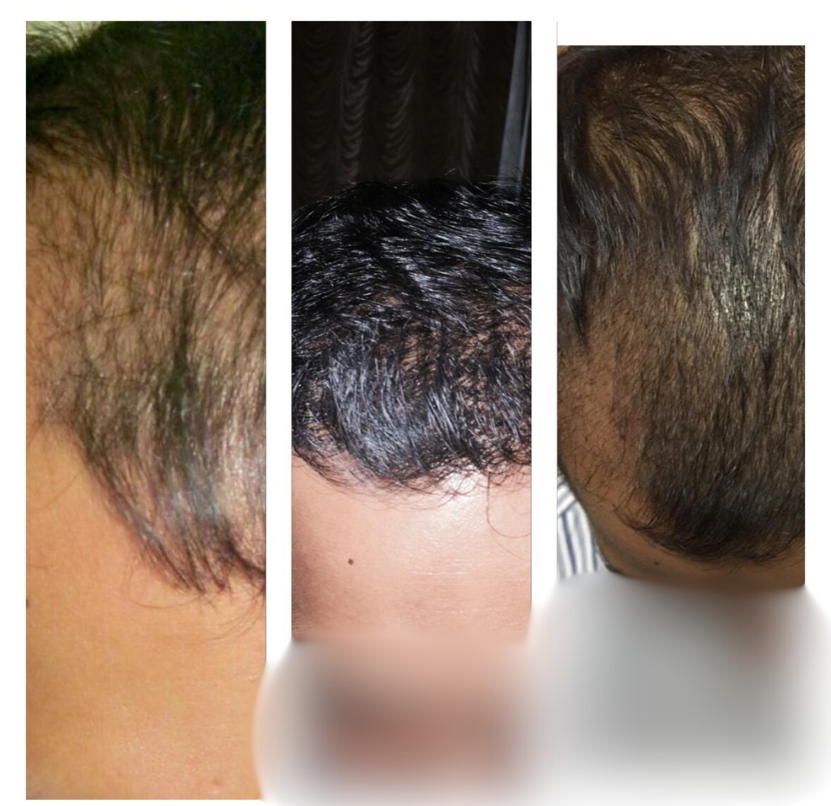 Before and After Treatment 1