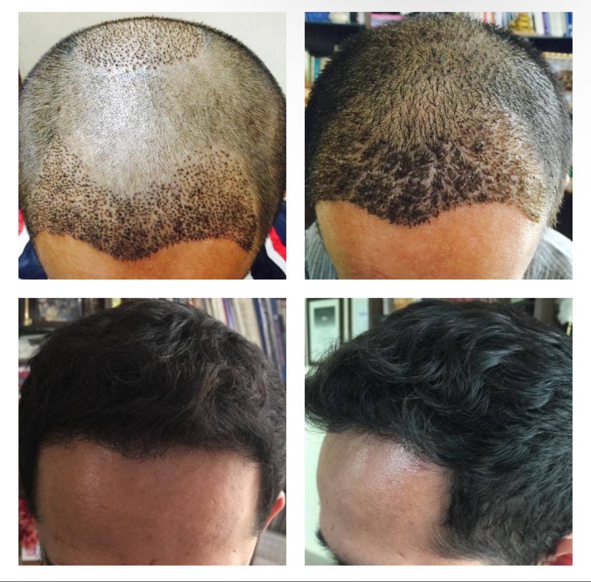 Before and After Treatment 1