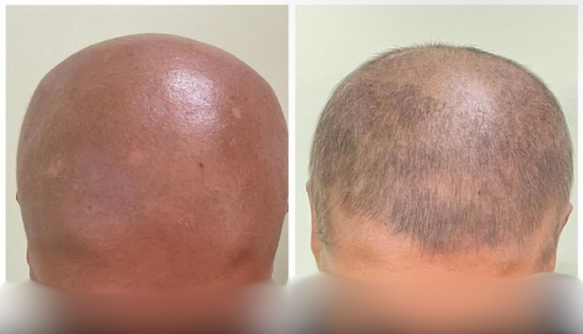 Before and After Treatment 1