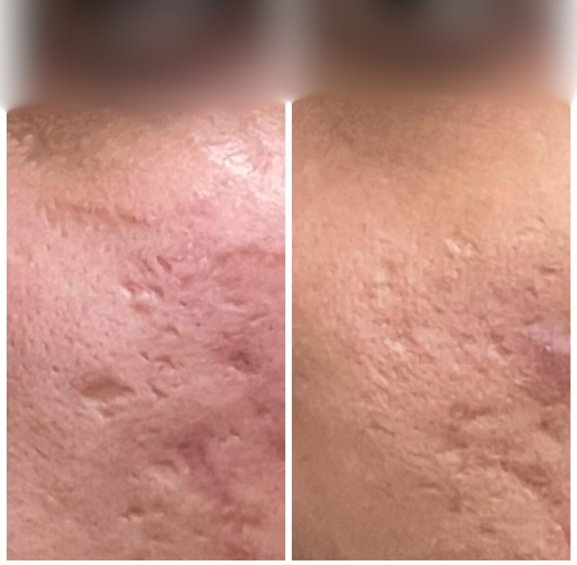 Before and After Treatment 2